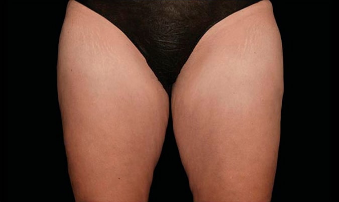 After CoolSculpting Body Contouring fat loss Treatment in Montreal