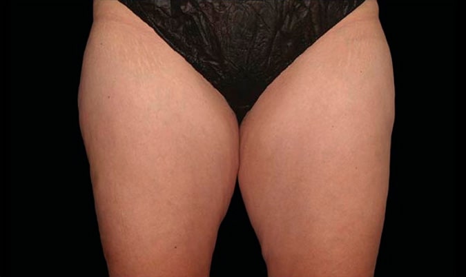 Before CoolSculpting Body Contouring fat loss Treatment in Montreal
