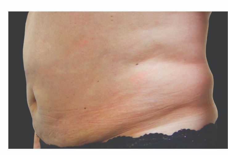 Before CoolSculpting Body Contouring fat loss Treatment in Montreal
