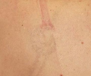 Before Fotona Laser Skin tattoo removal - Montreal