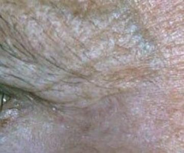 Before Fotona Laser Skin Treatment for eye wrinkles - Montreal