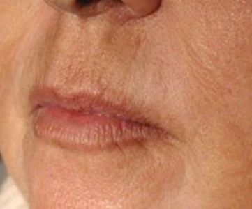 After Fotona Laser Skin Treatment for perioral wrinkles - Montreal