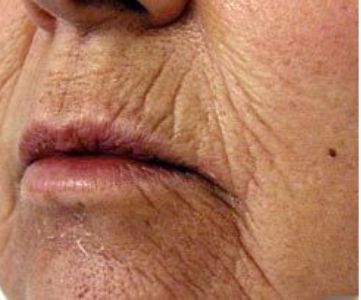 Before Fotona Laser Skin Treatment for perioral wrinkles - Montreal