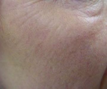 After Fotona Laser Skin Treatment for wrinkle resurfacing - Montreal