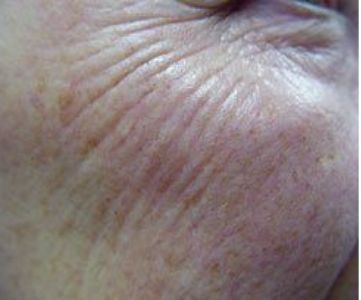 Before Fotona Laser Skin Treatment for wrinkle resurfacing - Montreal