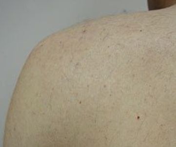 After Fotona Laser Skin Treatment for body hair removal - Montreal