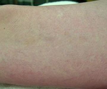 Before Fotona Laser Skin treatment spider veins - Montreal