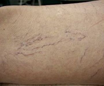 Before Fotona Laser Skin treatment spider veins - Montreal