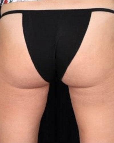 After Profound Radiofrequency Microneedling glutes and thighs treatment - Montreal