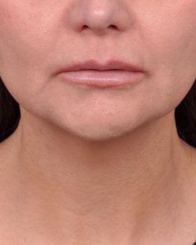 Before Profound Radiofrequency Microneedling Skin treatment to lift mouth marionette lines - Montreal