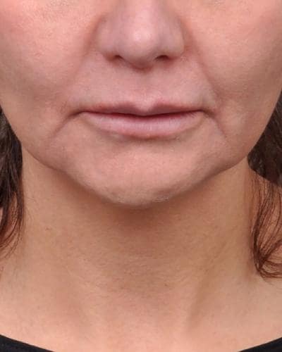 Before Profound Radiofrequency Microneedling Skin treatment to lift mouth marionette lines - Montreal