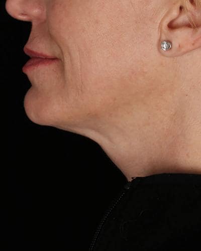 After double chin Profound Radiofrequency Microneedling Skin treatment - Montreal