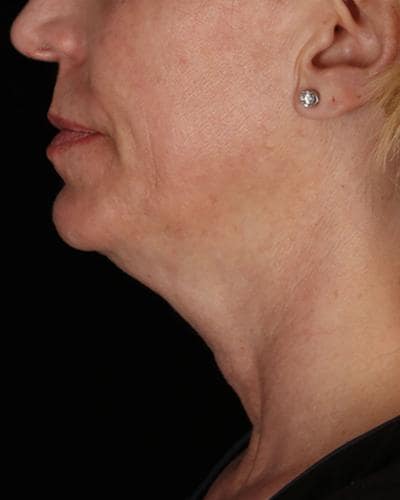 Before double chin Profound Radiofrequency Microneedling Skin treatment - Montreal