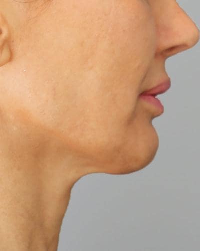 Before double chin Profound Radiofrequency Microneedling Skin treatment - Montreal