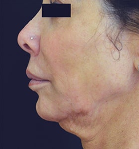 Patient before chin Scarlet-S RF treatment - Ideal Body Clinic Montreal