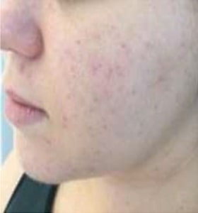 Patient after Scarlet-S RF treatment for acne and acne scars - Ideal Body Clinic Montreal