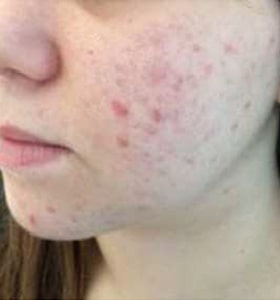Patient before Scarlet-S RF treatment for acne and acne scars - Ideal Body Clinic Montreal