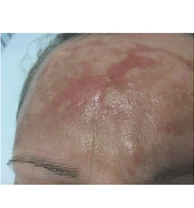 Patient before Scarlet-S RF treatment for burns - Ideal Body Clinic Montreal