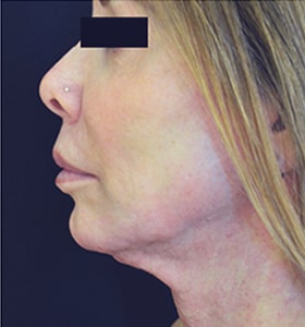 Patient after chin Scarlet-S RF treatment - Ideal Body Clinic Montreal
