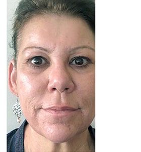 Patient after Scarlet-S RF treatment for wrinkles - Ideal Body Clinic Montreal
