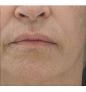 Patient before Scarlet-S RF treatment for mouth - Ideal Body Clinic Montreal