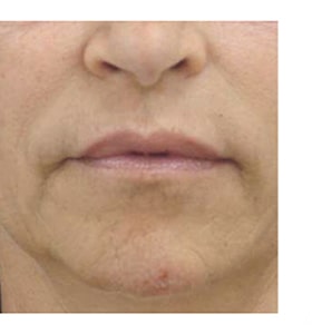 Patient after Scarlet-S RF treatment for mouth - Ideal Body Clinic Montreal