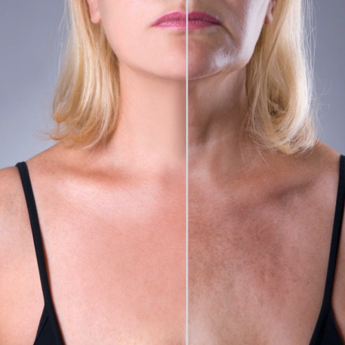 Woman's smoother skin and fewer wrinkles on chest and neck before and after skin rejuvenation treatments in Montreal