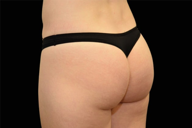 Butt lift After Emsculpt NEO Body Contouring fat removal therapy in Montreal