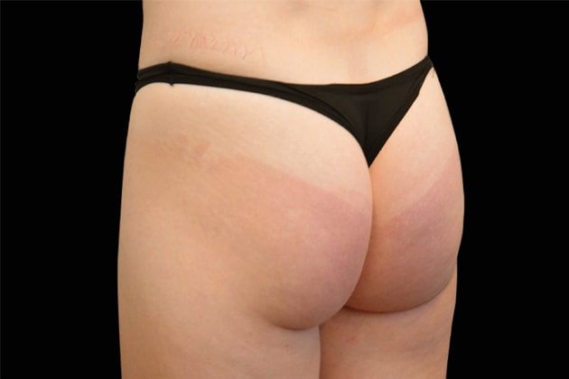 Butt lift Before Emsculpt NEO Body Contouring fat removal therapy in Montreal