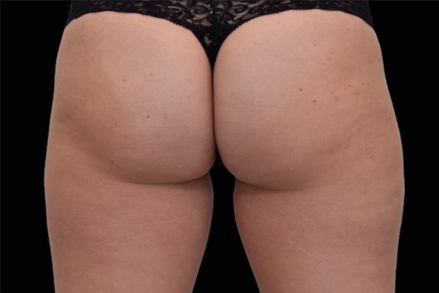 Female Buttocks After Emsculpt NEO Body Contouring fat removal therapy in Montreal