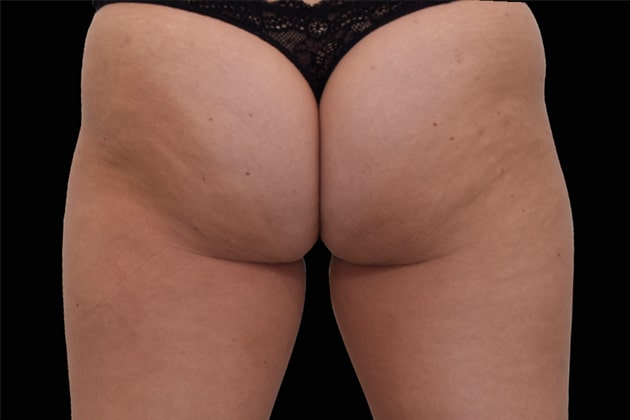 Female Buttocks Before Emsculpt NEO Body Contouring fat removal therapy in Montreal