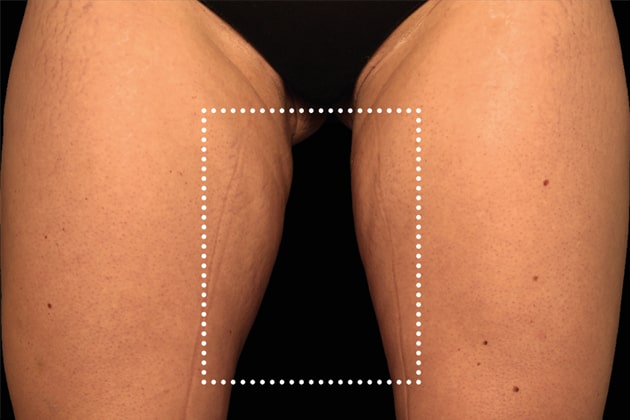 Thigh gap After Emsculpt NEO Body Contouring fat removal therapy in Montreal