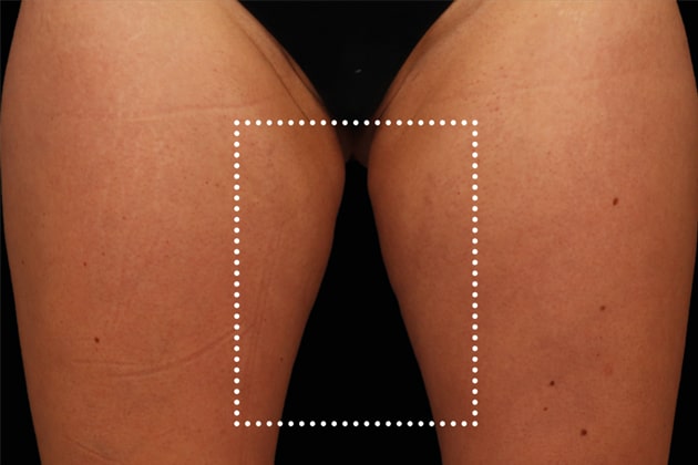 Thigh gap Before Emsculpt NEO Body Contouring fat removal therapy in Montreal