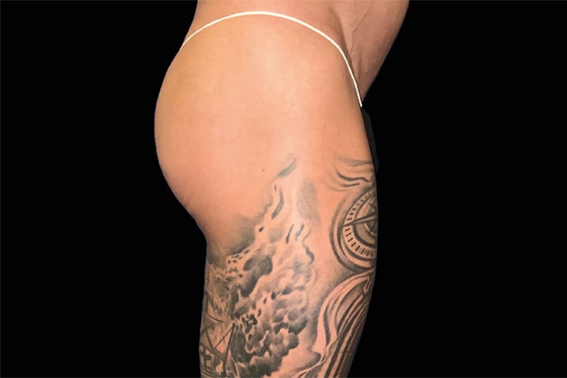 Male glutes After Emsculpt NEO Body Contouring fat removal therapy in Montreal