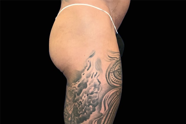 Male glutes Before Emsculpt NEO Body Contouring fat removal therapy in Montreal