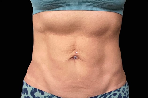 Mature woman abs Mature woman abs After Emsculpt NEO Body Contouring fat removal therapy in Montreal