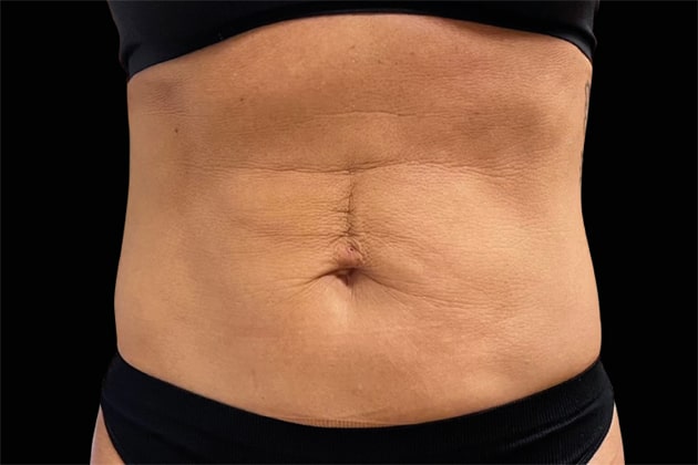 Mature woman abs Before Emsculpt NEO Body Contouring fat removal therapy in Montreal
