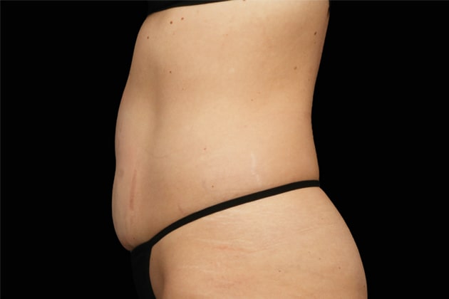 Stubborn belly fat After Emsculpt NEO Body Contouring fat removal therapy in Montreal