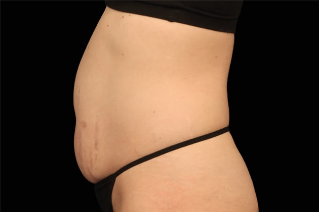 Stubborn belly fat Before Emsculpt NEO Body Contouring fat removal therapy in Montreal