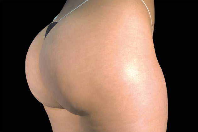 Female glutes After Emsculpt NEO Body Contouring fat removal therapy in Montreal