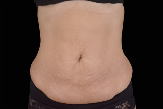 Sagging belly fat AfterEmsculpt NEO Body Contouring fat removal therapy in Montreal