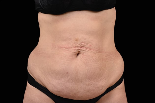 Sagging belly fat Before Emsculpt NEO Body Contouring fat removal therapy in Montreal