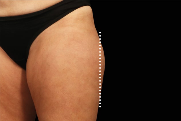 Thigh bulge Before Emsculpt NEO Body Contouring fat removal therapy in Montreal
