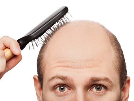 LT hair loss