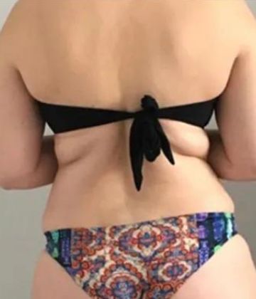 Muffin tops before Slimwave Montreal treatment at Ideal Body Clinic