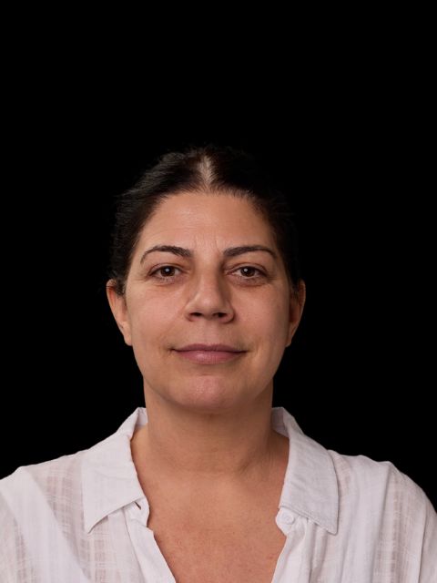 Before picture: trilift under the eye treatment in Montreal