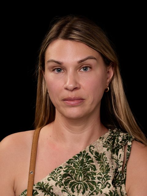 After picture: triLift non surgical face lift treatment for middle age woman in Montreal at Ideal Body Clinic