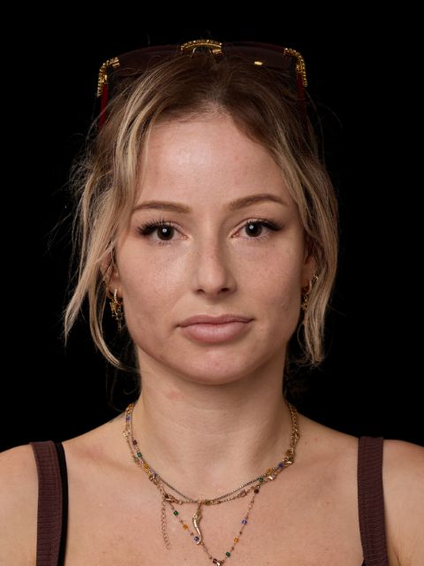 Before picture: triLift  treatment at Ideal Body Clinic on young patient