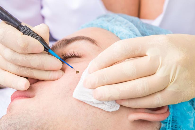 Une peau claire et uniforme commence ici : éliminez les grains de beauté, acrochordons, taches brunes et mélasma chez Ideal Body Clinic
