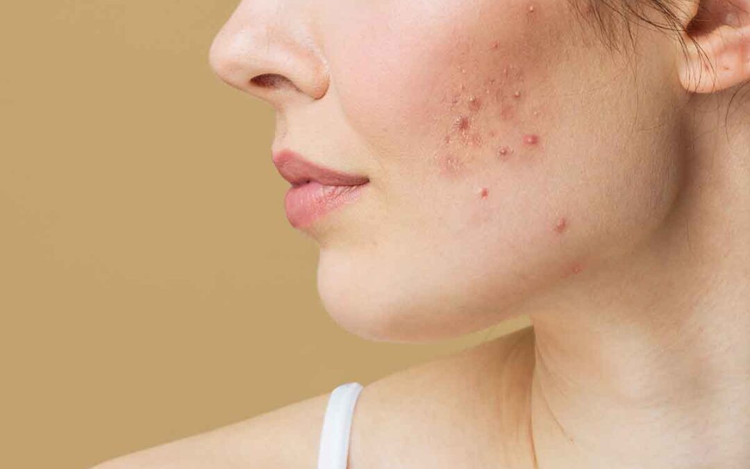 Acne Problems & Real Solutions in Montreal